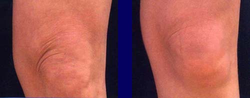  Ραδιοκύματα συν smart lipo laser συν μεσοθεραπεία 