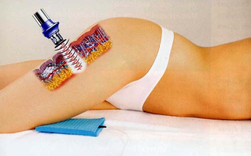 Radiofrequency